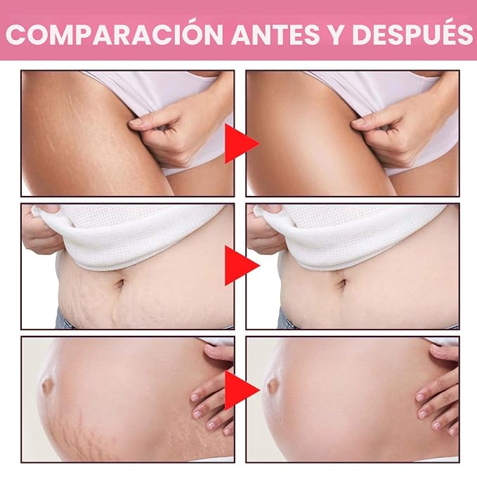 ADEUS Dile adiós a la celulitis